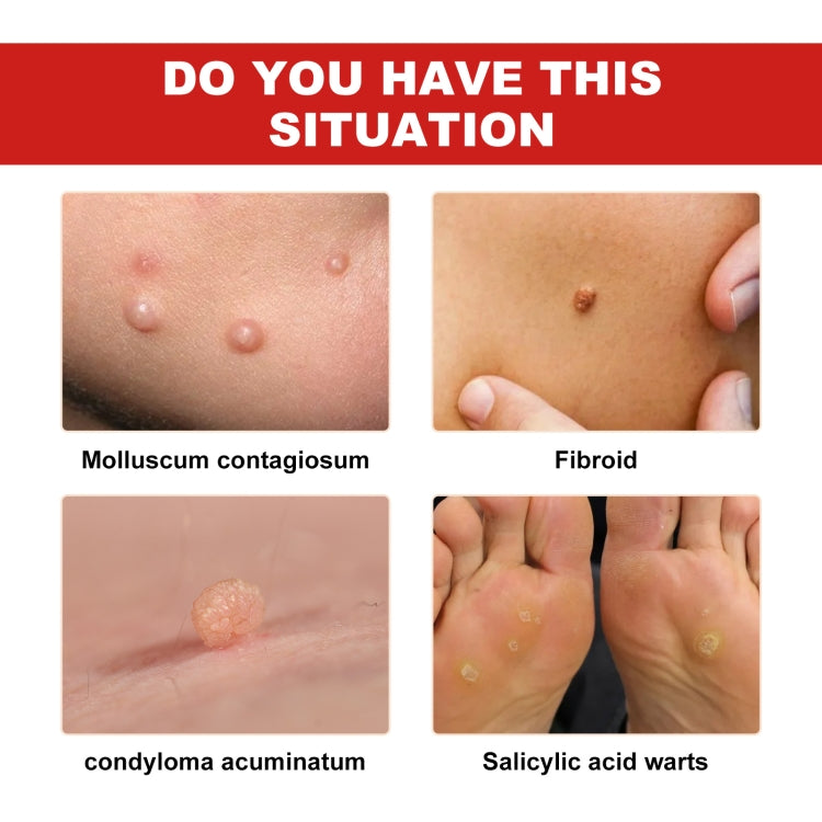 Ximonth 20ml/Bottle Anti Mole And Wart Liquid Dark Spot Tag Remover Skin Essence - free shipping - PMC TechLife - Order now!