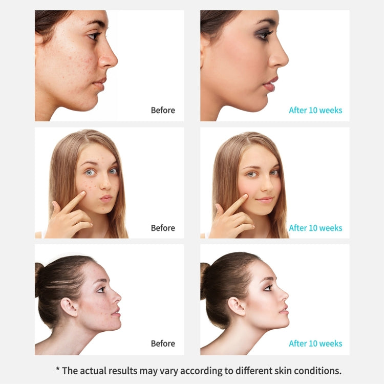 Xpreen Rechargeable Pore Cleanser Home Facial Beauty Device with LED Screen & 4 Probes - free shipping - PMC TechLife - Order now!