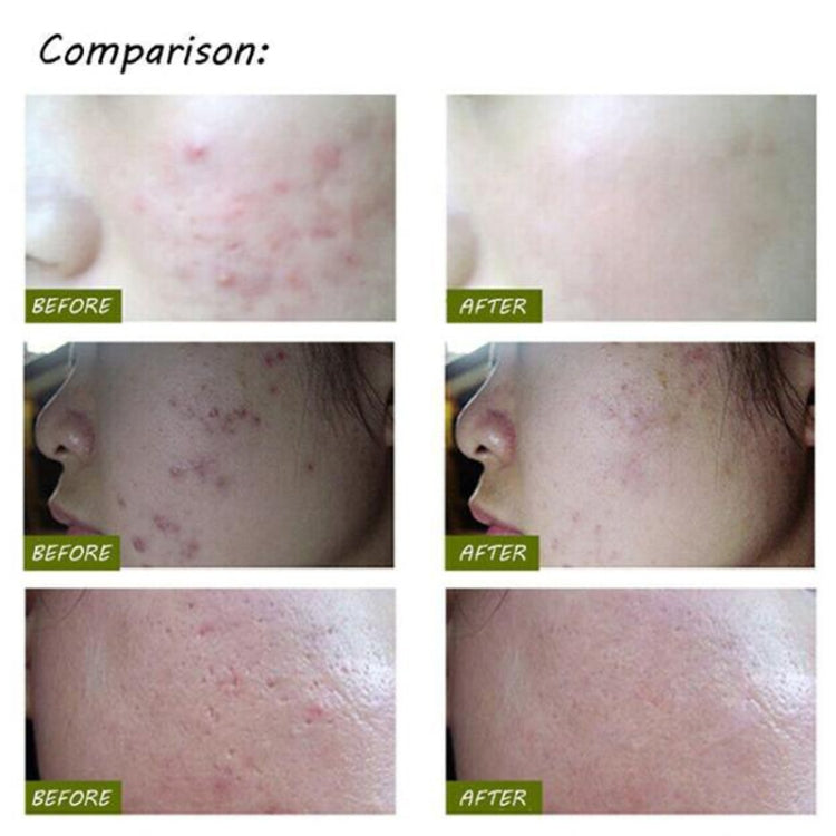 K-SKIN KD-7910 Acne Laser Pen Portable Wrinkle Removal Machine Durable Soft Scar Remover Device Blue Light Therapy Pen - free shipping - PMC TechLife - Order now!