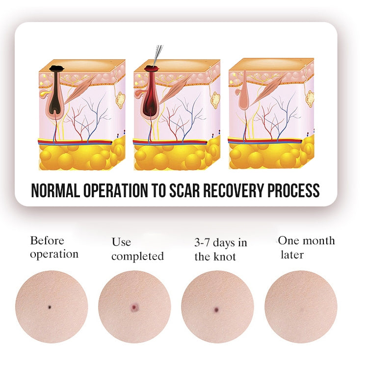 FY-106 Portable Mole and Freckle Removal Pen Household Laser Beauty Equipment(Green) - Clothing & Beauty by PMC TechLife | Online Shopping South Africa | PMC TechLife