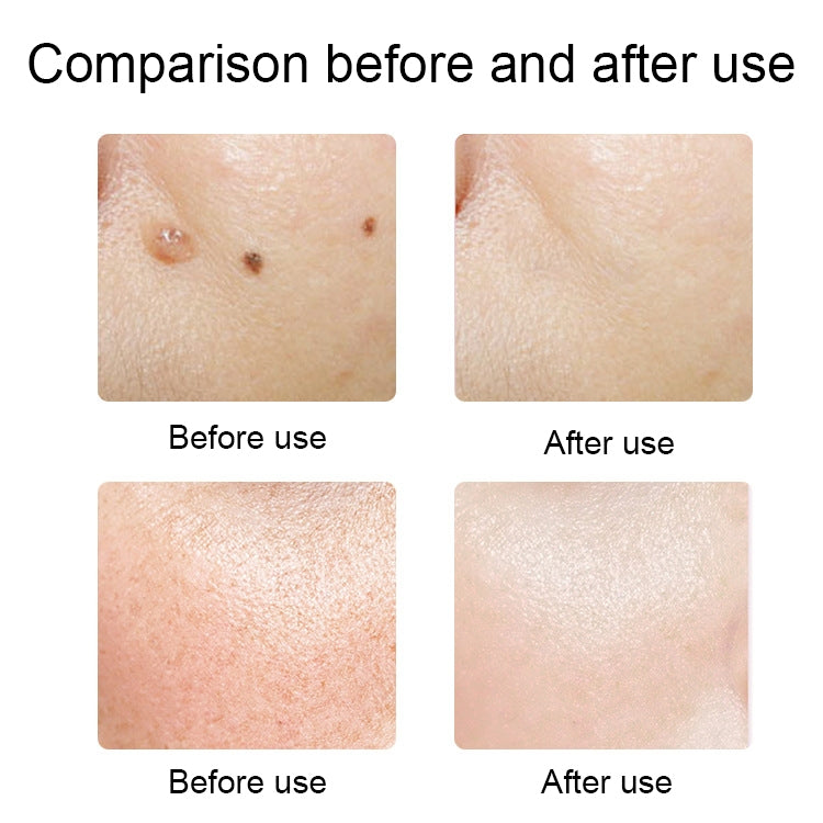 FY-106 Portable Mole and Freckle Removal Pen Household Laser Beauty Equipment(Rose Gold) - Clothing & Beauty by PMC TechLife | Online Shopping South Africa | PMC TechLife